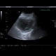 Acute cholecystitis, pericholecystitic abscess: US - Ultrasound